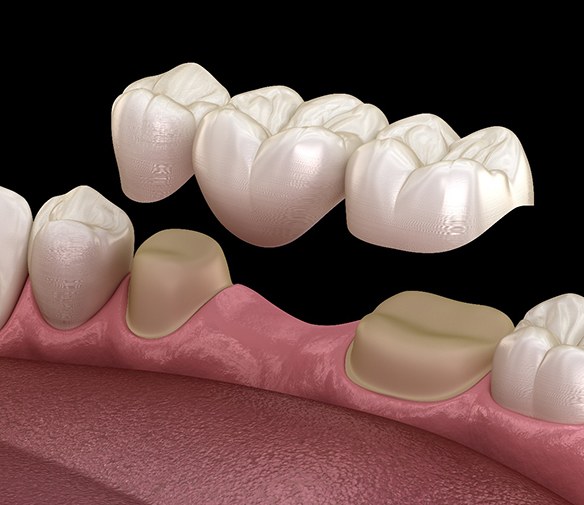 3D illustration of a dental bridge topping prepared teeth