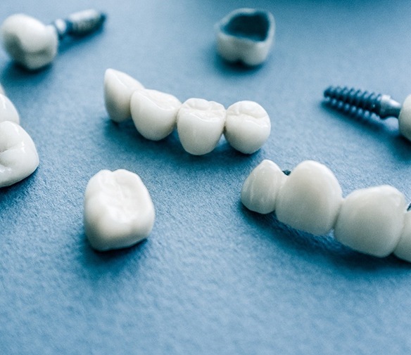 Different types of dental implants in Flint