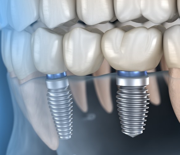 Animated smile with dental implant supported fixed brdige
