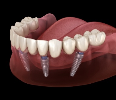 Animated dental implant supported denture placement