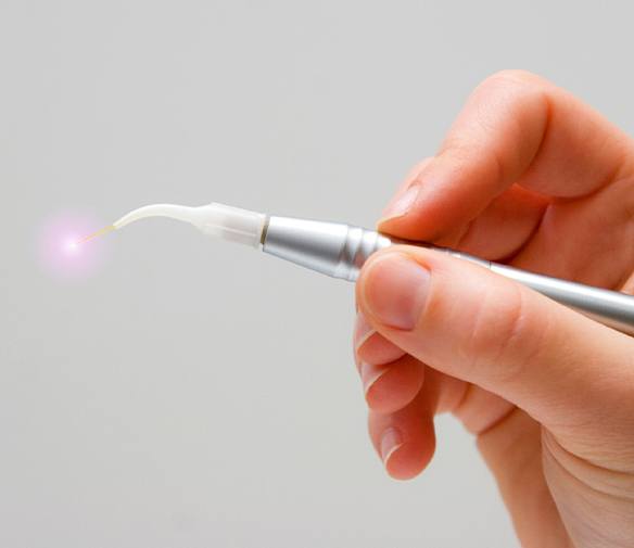 Soft tissue laser dentistry hand tool